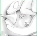 Obstetrical Forceps