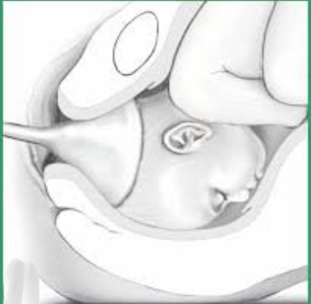 Obstetrical Forceps